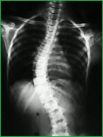 skolioz-rentgen